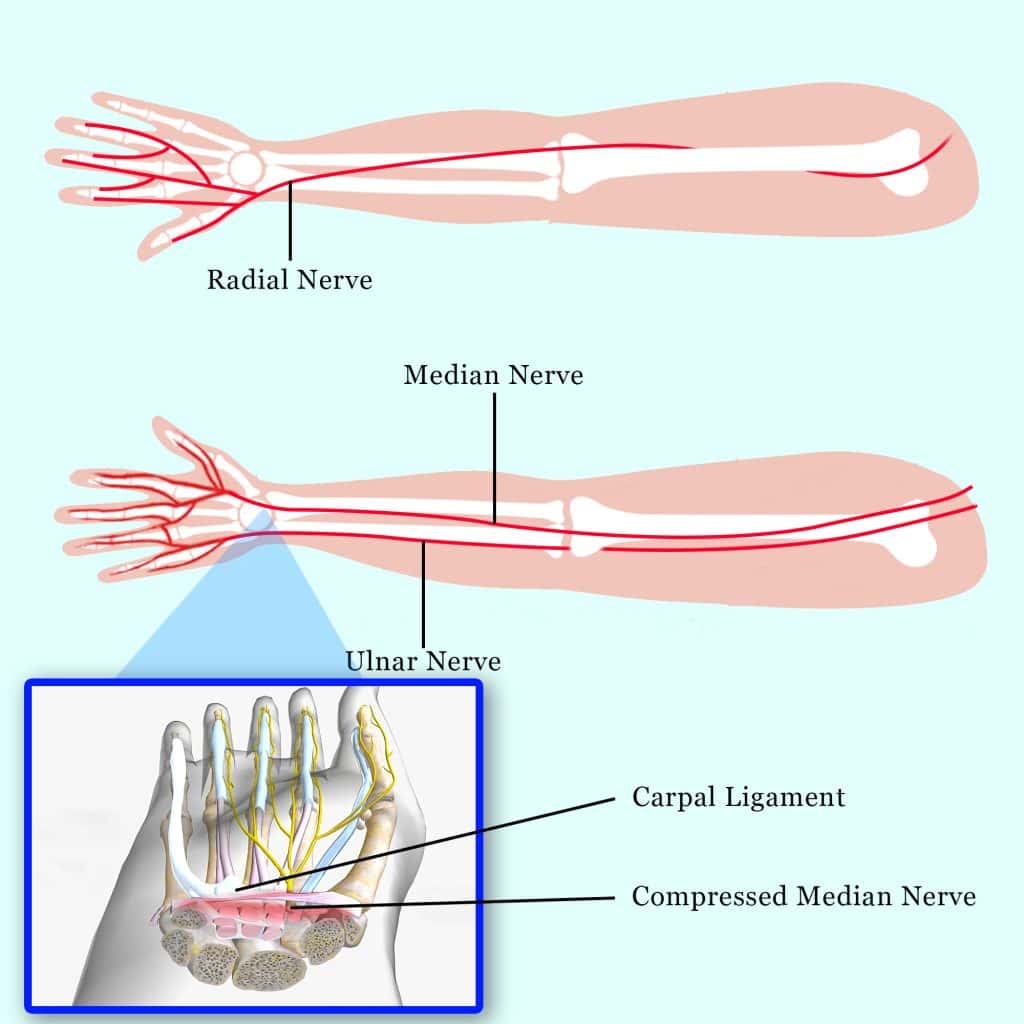 Nerve Compression