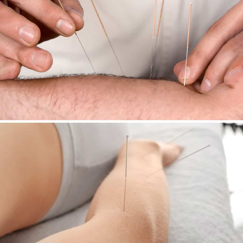 Acupuncture