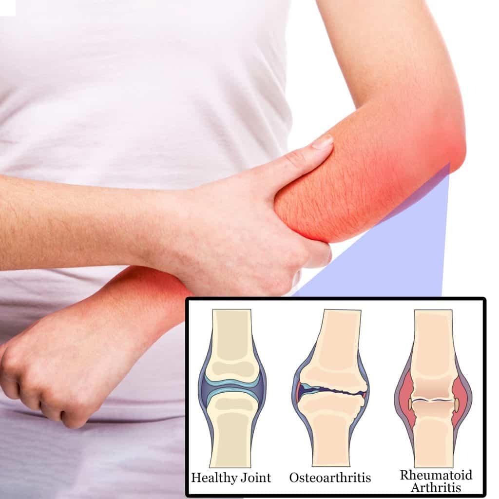 Arthritis