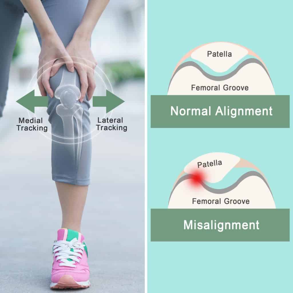 Understanding Patellar Tracking Disorder