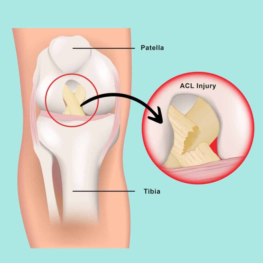 Previous Knee Injury